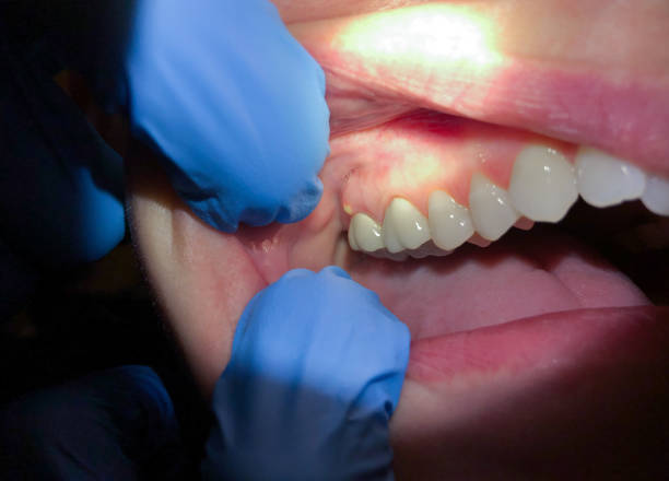 Best Broken or Cracked Tooth Emergency Dentist in Laurel Lake, NJ